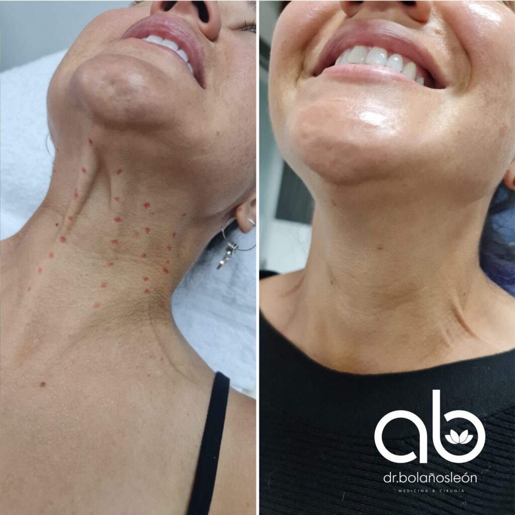 después-del-botox