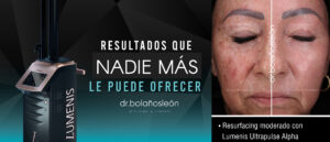 Resultado real de Lumenis Ultrapulse Alpha