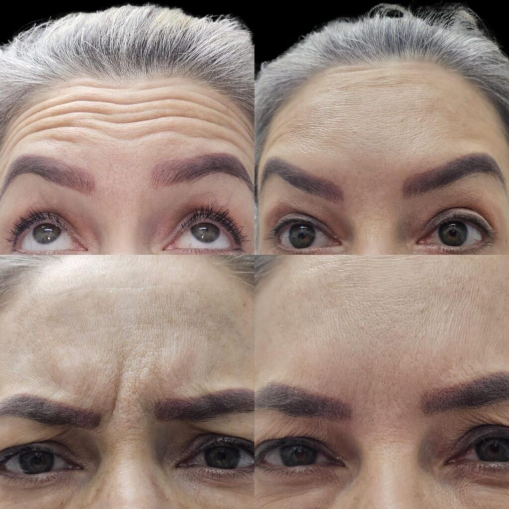 antes-del-botox