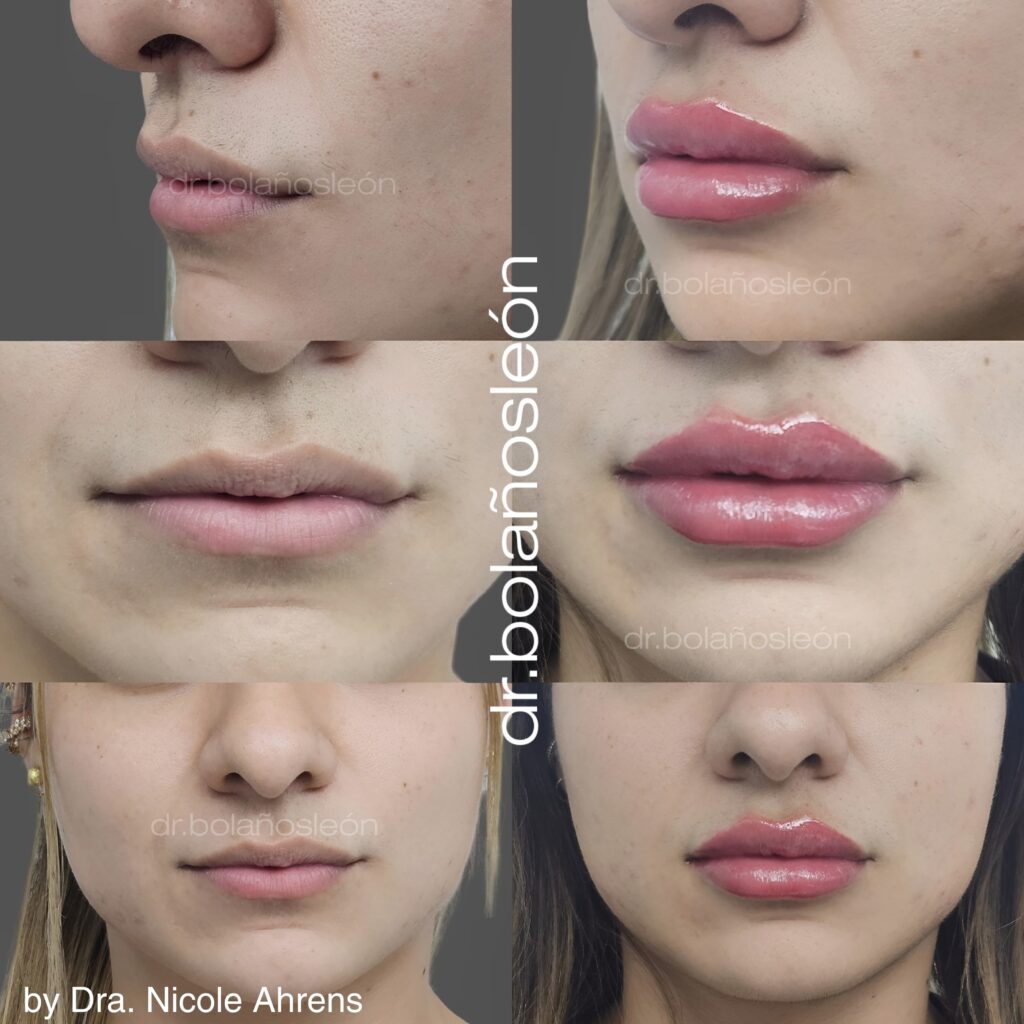 botox-antes-después
