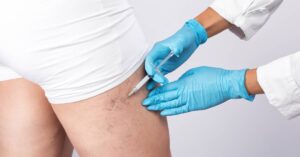 Escleroterapia-qué-es